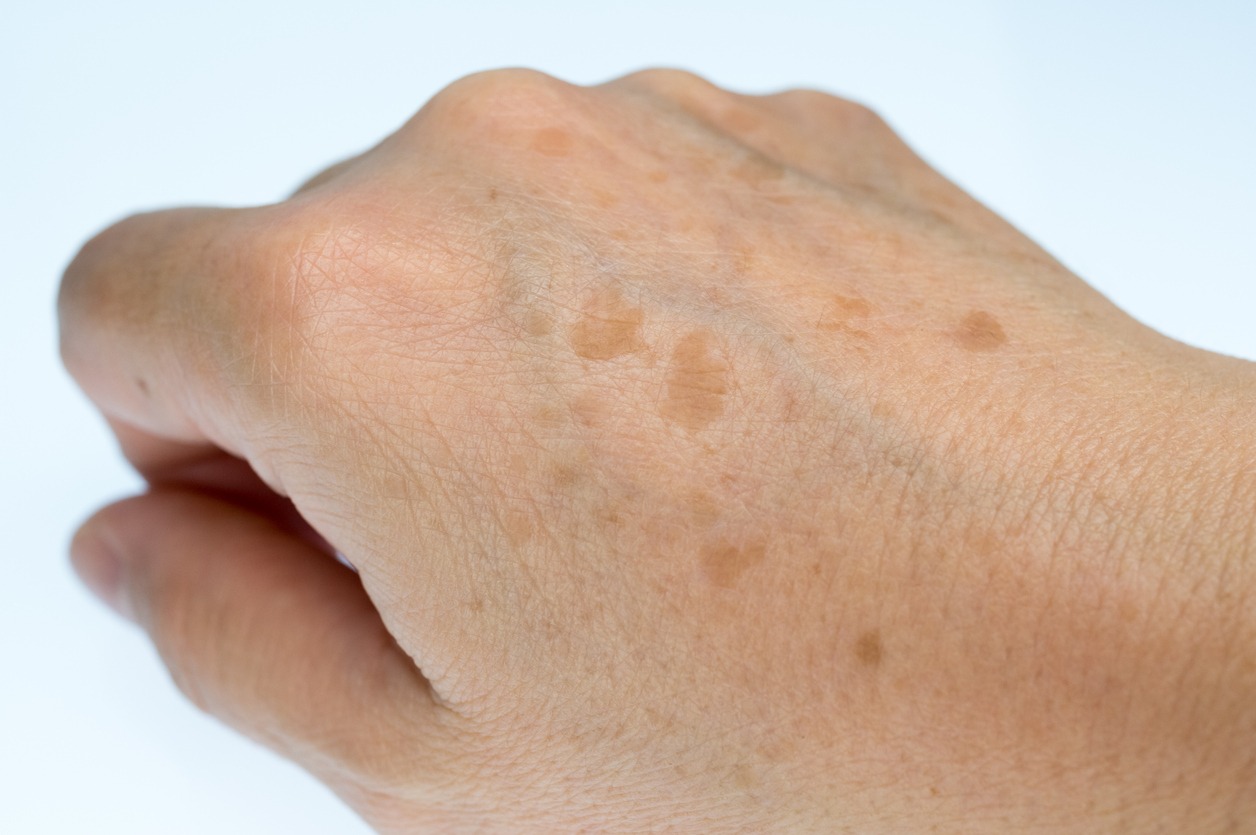 Hands of a woman with age spots