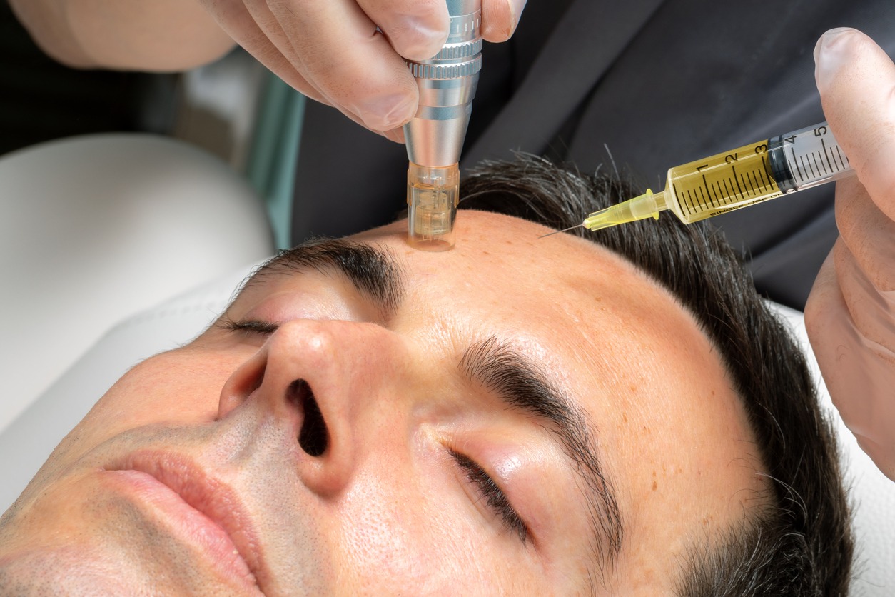 Micrneedling treatment on face of a man