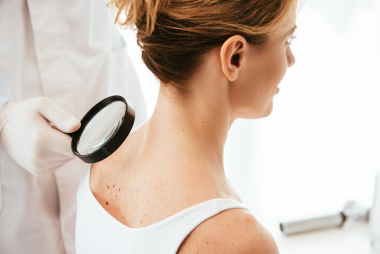 uitsnede van dermatoloog met vergrootglas tijdens onderzoek van vrouw met melanoom