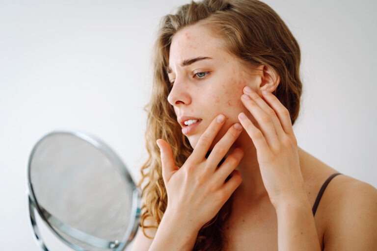 Girl with acne looking at herself in the mirror